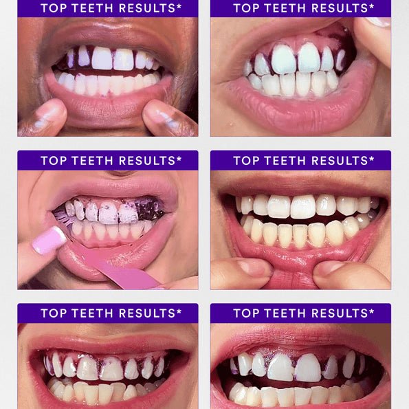 Hismile V34 Purple Whitening Strips (PAP+) - Era Giftware